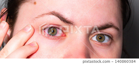 Red eye due to viral or bacterial infection. Eye doctor examining inflamed conjunctiva. Medical clinic photography for health articles Red eye due to viral or bacterial infection. Eye doctor examining inflamed conjunctiva. Medical clinic photography for health articles 140860384