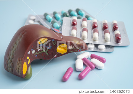 Liver model with pill drug treatment, Cirrhosis, Liver cancer, fatty liver. Liver model with pill drug treatment, Cirrhosis, Liver cancer, fatty liver. 140862073