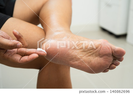 Asian woman check feet with crack and dry heel skin, Diabetic Foot. Asian woman check feet with crack and dry heel skin, Diabetic Foot. 140862696