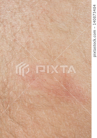 Contact dermatitis symptoms showing red inflamed bumps on human skin Contact dermatitis symptoms showing red inflamed bumps on human skin 140873484