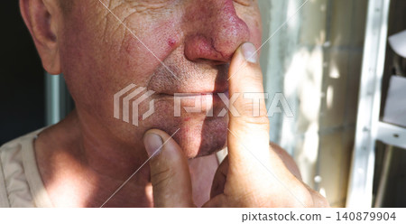 Close up view of a mature man face with phymatous rosacea and rhinophyma skin condition. Dermatological skin disease concept showing bulbous nose and facial redness. Close up view of a mature man face with phymatous rosacea and rhinophyma skin condition. Dermatological skin disease concept showing bulbous nose and facial redness. 140879904