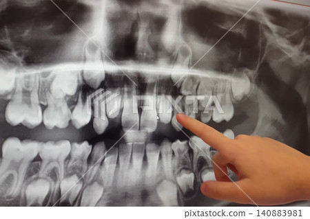 X-RAY PICTURE OF DAIRY AND NEW CHILDRENS TEETH. X-RAY PICTURE OF DAIRY AND NEW CHILDRENS TEETH. 140883981