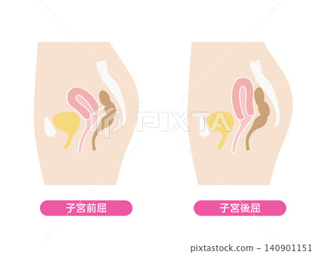 A set of illustrations for anteverted and retroverted uteruses. A set of illustrations for anteverted and retroverted uteruses. 140901151