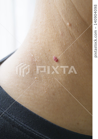 Warts on the neck Warts on the neck 140904098
