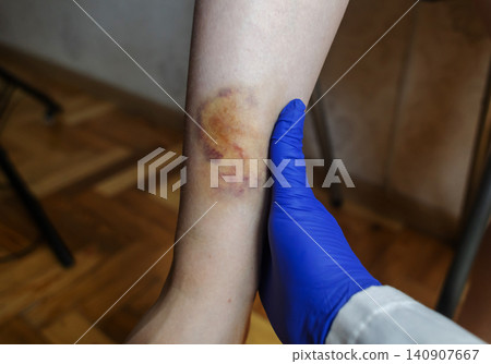 Doctor in blue gloves treating a large bruise and hematoma on a child leg. Medical care, first aid and treatment for pediatric skin injury or contusion. Doctor in blue gloves treating a large bruise and hematoma on a child leg. Medical care, first aid and treatment for pediatric skin injury or contusion. 140907667
