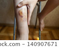 Doctor in blue gloves treating a large bruise and hematoma on a child leg. Medical care, first aid and treatment for pediatric skin injury or contusion. Doctor in blue gloves treating a large bruise and hematoma on a child leg. Medical care, first aid and treatment for pediatric skin injury or contusion. 140907671