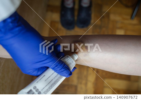 Doctor in blue gloves treating a large bruise and hematoma on a child leg. Medical care, first aid and treatment for pediatric skin injury or contusion. Doctor in blue gloves treating a large bruise and hematoma on a child leg. Medical care, first aid and treatment for pediatric skin injury or contusion. 140907672