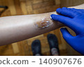 Doctor in blue gloves treating a large bruise and hematoma on a child leg. Medical care, first aid and treatment for pediatric skin injury or contusion. Doctor in blue gloves treating a large bruise and hematoma on a child leg. Medical care, first aid and treatment for pediatric skin injury or contusion. 140907676