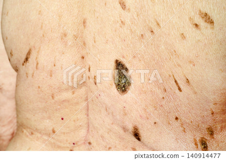 Aging skin showing multiple seborrheic keratoses and skin lesions Aging skin showing multiple seborrheic keratoses and skin lesions 140914477