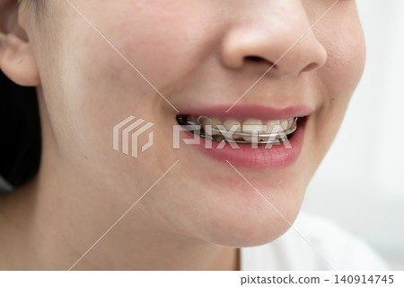 Asian woman wearing Hawley retainer removable orthodontic appliance maintain position of teeth. Asian woman wearing Hawley retainer removable orthodontic appliance maintain position of teeth. 140914745