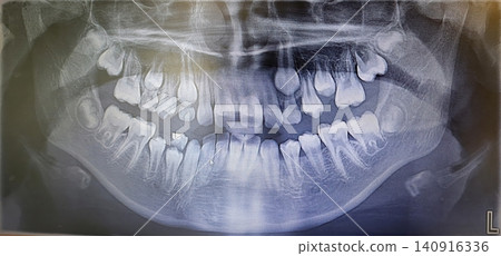 Comprehensive X-ray imaging and analysis of the child's oral health and tooth structure during the period of baby teeth replacement 140916336