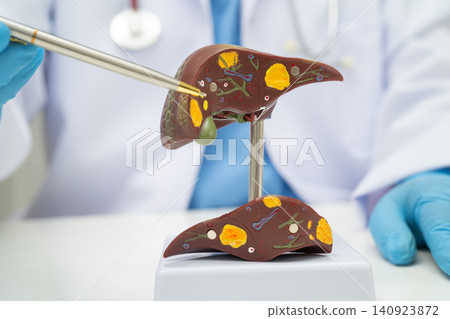 Cirrhosis, Liver cancer, fatty liver, Asian doctor with liver human model. Cirrhosis, Liver cancer, fatty liver, Asian doctor with liver human model. 140923872