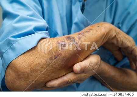 Ecchymosis, elderly bleeding on her arm after taking aspirin. Ecchymosis, elderly bleeding on her arm after taking aspirin. 140934460