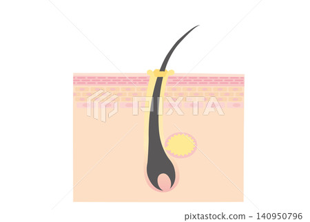 Cross-section of a scalp and pores clogged with sebum. Cross-section of a scalp and pores clogged with sebum. 140950796