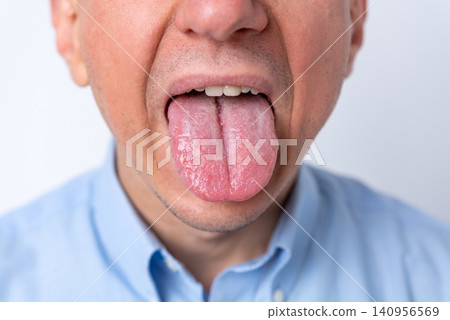 Man showing his tongue with a thick white coating and visible fissure, signifying potential health issues and the importance of checking oral hygiene for diagnosis Man showing his tongue with a thick white coating and visible fissure, signifying potential health issues and the importance of checking oral hygiene for diagnosis 140956569