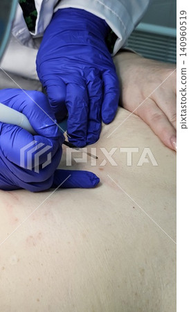 Post procedure skin treatment with antiseptic swab after papilloma and mole removal Post procedure skin treatment with antiseptic swab after papilloma and mole removal 140960519