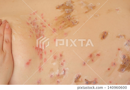 Applying healing cream after papilloma wart and mole removal during skin recovery care Applying healing cream after papilloma wart and mole removal during skin recovery care 140960600
