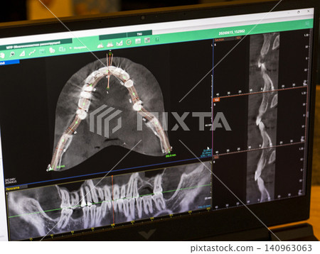 Laptop screen displaying professional dental diagnostic software with a 3D panoramic jawbone model and cross-sectional root slices. Laptop screen displaying professional dental diagnostic software with a 3D panoramic jawbone model and cross-sectional root slices. 140963063