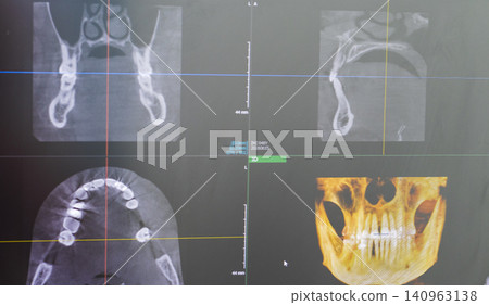 Dental cone beam computed tomography or CBCT diagnostic scan software displaying multi-planar views and a 3D maxillofacial reconstruction model. Healthcare Dental cone beam computed tomography or CBCT diagnostic scan software displaying multi-planar views and a 3D maxillofacial reconstruction model. Healthcare 140963138