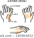 爪畸形（爪狀指） 140964832
