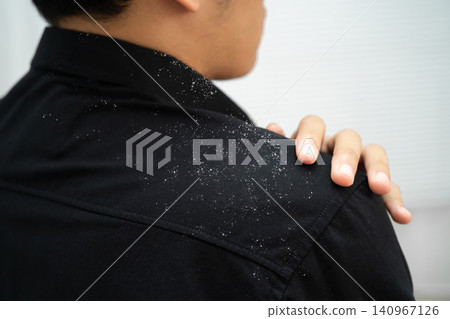Man with dandruff on shirt at shoulder. Man with dandruff on shirt at shoulder. 140967126