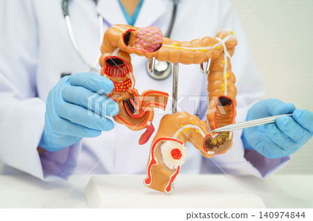 Colorectal cancer, doctor holding intestine colon human anatomy model. 140974844