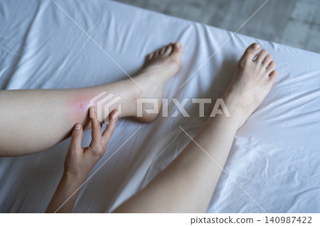 Girl sitting on bed at home applying cream on swollen skin leg from mosquito or midge bites. Allergy Girl sitting on bed at home applying cream on swollen skin leg from mosquito or midge bites. Allergy 140987422