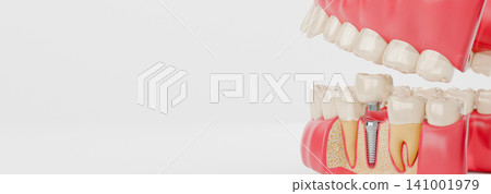 3D illustration of a dental implant model showing crown, abutment, and titanium screw anchored in jawbone 3D illustration of a dental implant model showing crown, abutment, and titanium screw anchored in jawbone 141001979
