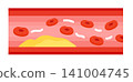 Cross-sectional illustration of an arteriosclerotic blood vessel (vascular stenosis due to cholesterol) 141004745