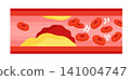 Cross-sectional illustration of an arteriosclerotic blood vessel with a blood clot. 141004747