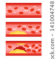 A set of illustrations comparing healthy blood vessels with arteriosclerosis and blood clots. 141004748