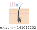 Cross-sectional illustration of a dry scalp with dandruff due to lack of moisture. 141012202