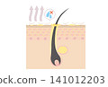Cross-sectional illustration of a scalp with excessive sebum secretion due to dryness. 141012203