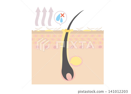 Cross-sectional illustration of a scalp with excessive sebum secretion due to dryness. Cross-sectional illustration of a scalp with excessive sebum secretion due to dryness. 141012203