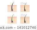 A set of four illustrations showing cross-sections of a healthy scalp and a scalp with various problems. 141012740