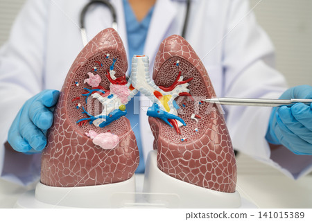 Pneumonia, lung cancer, Asian doctor with human lung model. 141015389