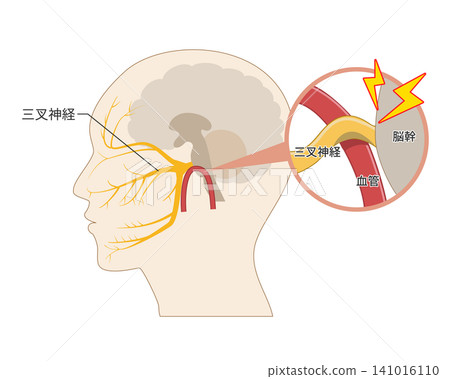 Diagram illustrating the mechanism by which blood vessels compress the trigeminal nerve, causing pain (medical and anatomical reference material) Diagram illustrating the mechanism by which blood vessels compress the trigeminal nerve, causing pain (medical and anatomical reference material) 141016110