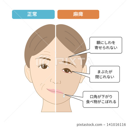 圖示對比臉部不對稱和顏面神經麻痺引起的症狀。 圖示對比臉部不對稱和顏面神經麻痺引起的症狀。 141016116