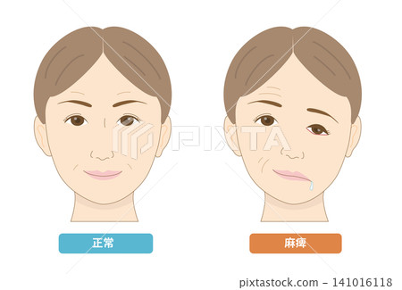 圖示對比臉部不對稱和顏面神經麻痺引起的症狀。 圖示對比臉部不對稱和顏面神經麻痺引起的症狀。 141016118