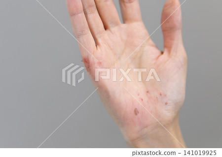 一位女士受傷的、纖細的手 一位女士受傷的、纖細的手 141019925