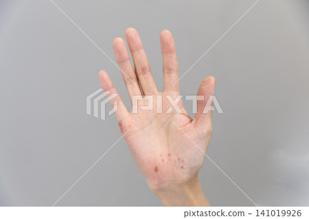 一位女士受傷的、纖細的手 一位女士受傷的、纖細的手 141019926