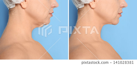 Mature woman before and after plastic surgery operation on blue background, closeup Mature woman before and after plastic surgery operation on blue background, closeup 141028381