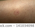 midge parasites 141034098