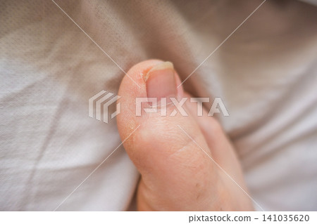 Close Up of Overgrown Big Toenail with Dry Skin Close Up of Overgrown Big Toenail with Dry Skin 141035620