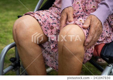 Asian elderly woman patient show her scars surgical total knee joint replacement Suture wound surgery arthroplasty on bed in nursing hospital ward, healthy strong medical concept. Asian elderly woman patient show her scars surgical total knee joint replacement Suture wound surgery arthroplasty on bed in nursing hospital ward, healthy strong medical concept. 141047830
