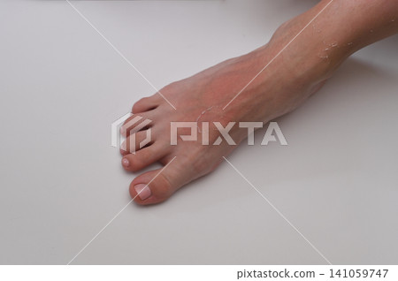 Sunburned foot with redness and peeling skin, clear signs of overexposure to sun, focus on feet and toes, natural outdoor scene, emphasizing need for sun protection and skincare after sun exposure Sunburned foot with redness and peeling skin, clear signs of overexposure to sun, focus on feet and toes, natural outdoor scene, emphasizing need for sun protection and skincare after sun exposure 141059747
