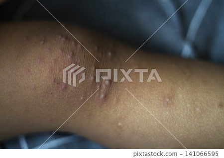 Red Rash On Toddler Foot From Hand Foot Mouth Disease Red Rash On Toddler Foot From Hand Foot Mouth Disease 141066595