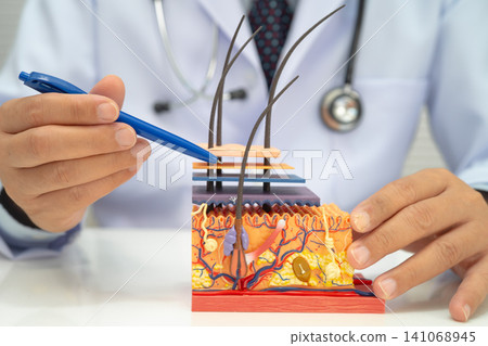 Hair transplant, Asian dermatologist doctor holding skin structure anatomy model for treatment in hospital. Hair transplant, Asian dermatologist doctor holding skin structure anatomy model for treatment in hospital. 141068945