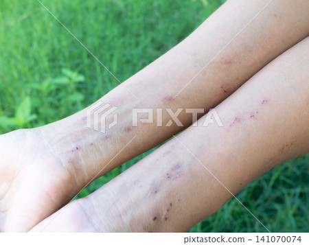 Hand with urticaria allergy itchy rash eczema itch woman from food,grass,Air poisoning,cosmetic,health,body care disease lilness air,dissease medicine calamine Lotion Treatment ,infection pain scratch Hand with urticaria allergy itchy rash eczema itch woman from food,grass,Air poisoning,cosmetic,health,body care disease lilness air,dissease medicine calamine Lotion Treatment ,infection pain scratch 141070074