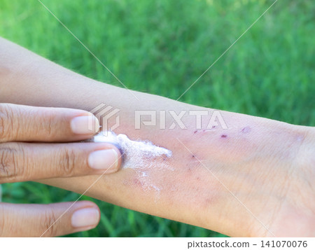 Hand with urticaria allergy itchy rash eczema itch woman from food,grass,Air poisoning,cosmetic,health,body care disease lilness air,dissease medicine calamine Lotion Treatment ,infection pain scratch Hand with urticaria allergy itchy rash eczema itch woman from food,grass,Air poisoning,cosmetic,health,body care disease lilness air,dissease medicine calamine Lotion Treatment ,infection pain scratch 141070076